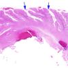 7A1 Artifact, autolysis, prior hypoxia-ischemia, Case 9) H&E 2