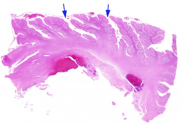 7A1 Artifact, autolysis, prior hypoxia-ischemia, Case 9) H&E 2