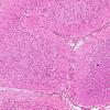 7A2 Artifact, autolysis, prior hypoxia-ischemia, Case 9) H&E 3