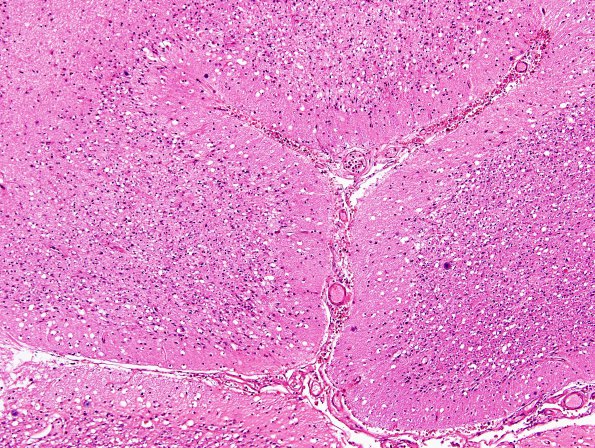 7A2 Artifact, autolysis, prior hypoxia-ischemia, Case 9) H&E 3