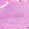 7A3 Artifact, autolysis, prior hypoxia-ischemia, Case 9) H&E 4