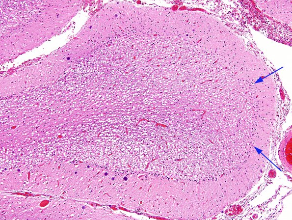 7A3 Artifact, autolysis, prior hypoxia-ischemia, Case 9) H&E 4