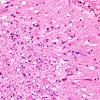 7A4 Artifact, autolysis, prior hypoxia-ischemia, Case 9) H&E 5