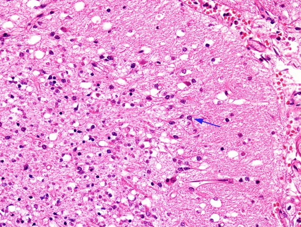 7A4 Artifact, autolysis, prior hypoxia-ischemia, Case 9) H&E 5