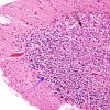 7A5 Artifact, autolysis, prior hypoxia-ischemia, Case 9) H&E 7