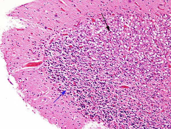 7A5 Artifact, autolysis, prior hypoxia-ischemia, Case 9) H&E 7