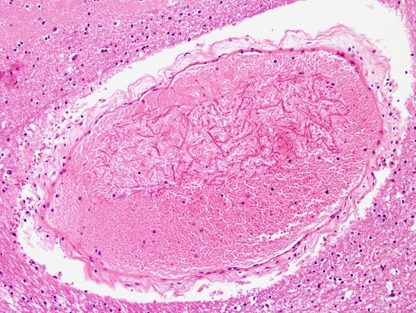 1 Artifact, fibrin fibrils (Case 4) H&E 1