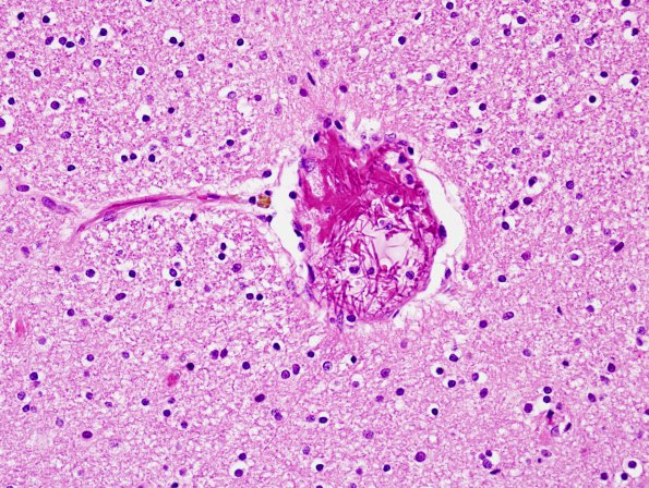 2 Artifact, fibrin fibrils (Case 2) H&E 1