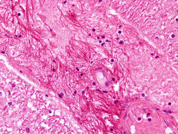 3 Artifact, fibrin (Case 3) H&E 2