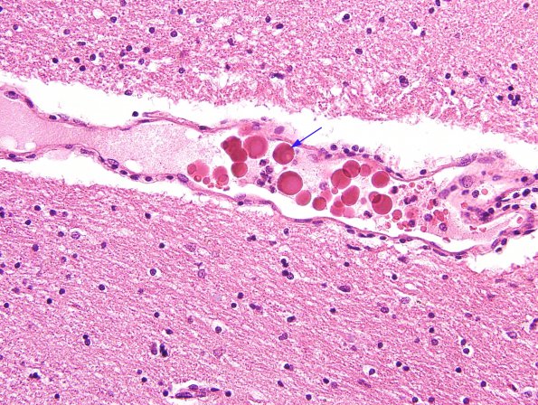 4 Artifact, fibrin, intravascular (Case 5) H&E 3