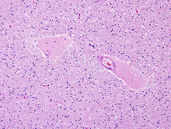 5 Artifact, fibrin, perivascular  (Case 6) H&E