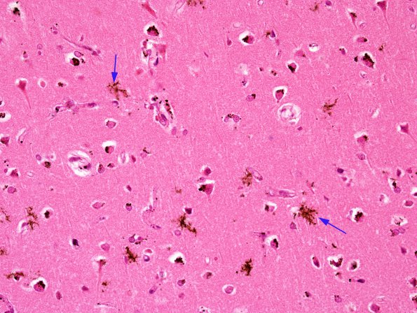 1A1 Artifact, formalin pigment (Case 3) H&E 2