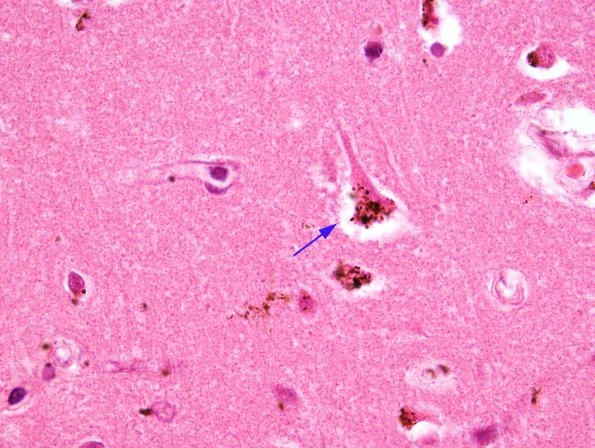 1A2 Artifact, formalin pigment (Case 3) H&E 6