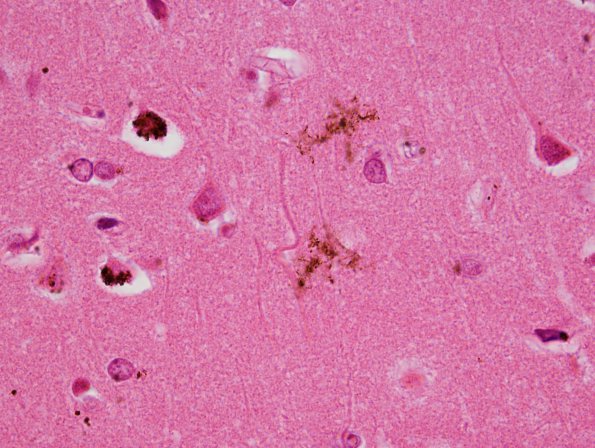 1A3 Artifact, formalin pigment (Case 3) H&E 7