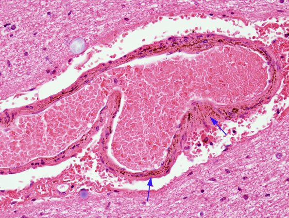 2 Artifact, formalin pigment 1 (Case 4)  N9 H&E 2