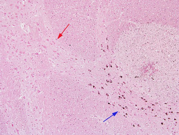 3A2 Formalin pigment (Case 6) N7 Iron stain 10X 1