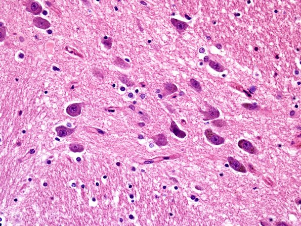 3A4 Formalin pigment (Case 6) N7 H&E 40X 1 adjacent area