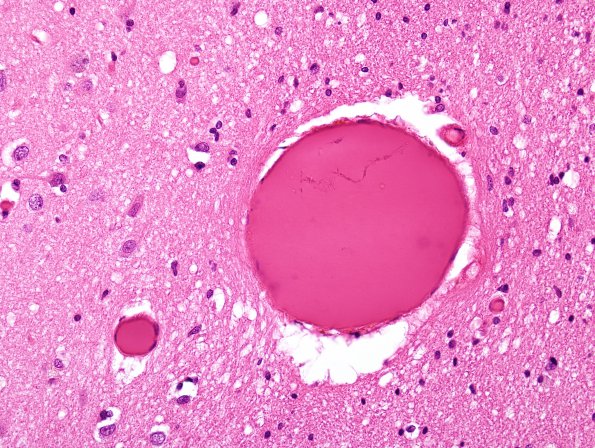 1A1 Artifact, formic acid CJD (Case 1) H&E 2