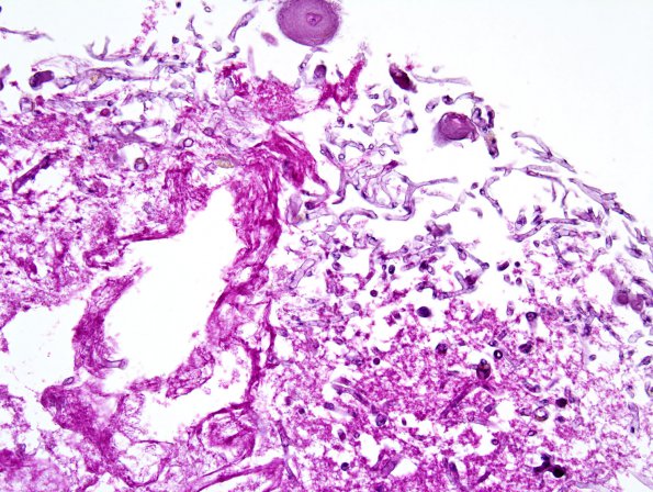 2A1 Artifact, formic acid overdigestion (Case 2) H&E 1