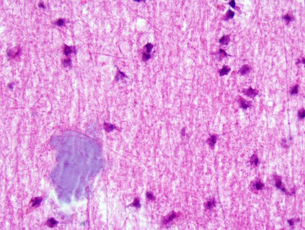 2A10 Artifact, formic acid overdigestion, corpora amylacea (Case 2) H&E 2