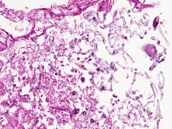 2A2 Artifact, formic acid overdigestion (Case 2) H&E 2