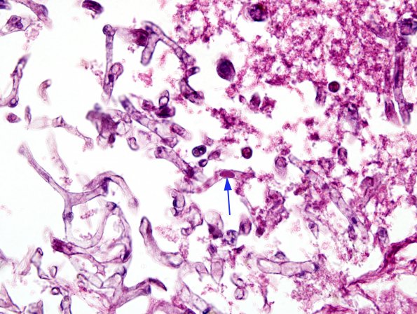 2A3 Artifact, formic acid overdigestion (Case 2) H&E 3 (iintravascular rbc)