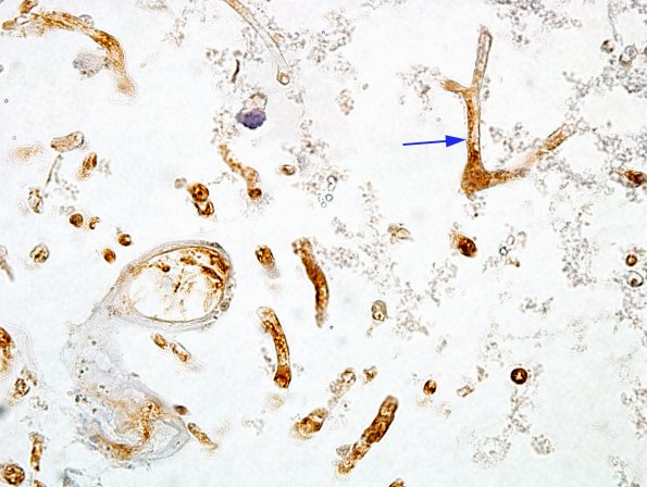 2A6 Artifact, formic acid overdigestion (Case 2) CD31 2 100X