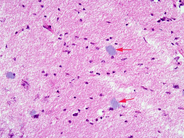 2A9 Artifact, formic acid overdigestion, corpora amylacea (Case 2) H&E 1