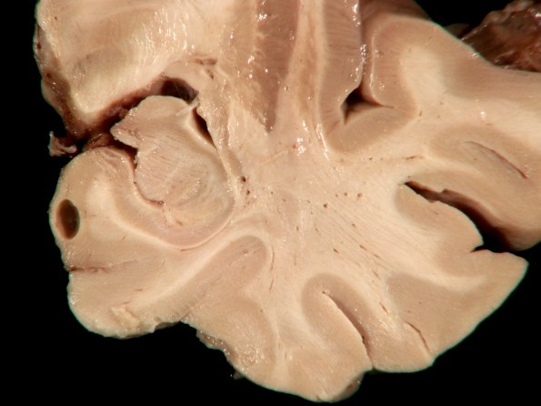 1A1 Artifact, frozen half brain (L) into formalin without thawing first (Case 2) 1