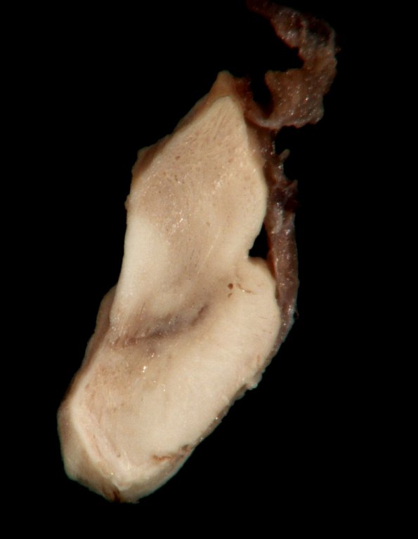 1A2 Artifact, frozen half brain (L) into formalin without thawing (Case 2) 2