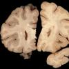 1A3 Artifact, frozen half brain (L) into formalin without thawing vs fixed (R) (Case 2) 2