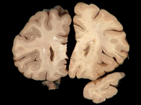 1A3 Artifact, frozen half brain (L) into formalin without thawing vs fixed (R) (Case 2) 2