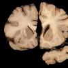 1A4 Artifact, frozen half brain (L) into formalin without thawing vs fixed (R) (Case 2) 3