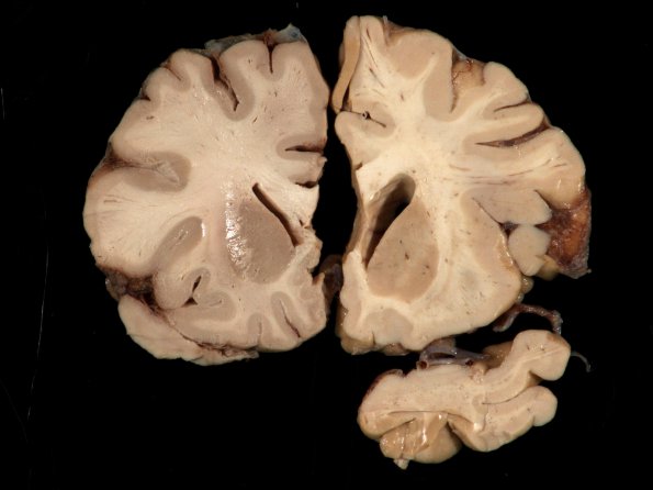 1A4 Artifact, frozen half brain (L) into formalin without thawing vs fixed (R) (Case 2) 3