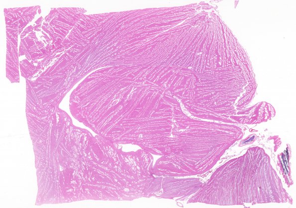 1B1 Artifact, frozen hippocampus into formalin without thawing (Case 2) H&E 1 whole mount