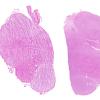 1B2 Artifact, frozen half medulla (L) into formalin without thawing vs fixed (R) (Case 2) H&E 4 whole mount