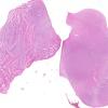 1B3 Artifact, frozen 3 half midbrain (L) into formalin without thawing vs fixed (R) (Case 2) H&E 5 whole mount 3