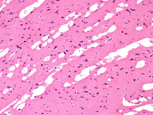 1B4 Artifact, frozen half brain into formalin without thaw, Case 2) H&E 2