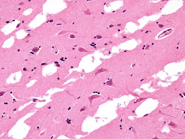 1B5 Artifact, frozen half brain into formalin without thaw, Case 2) H&E 4