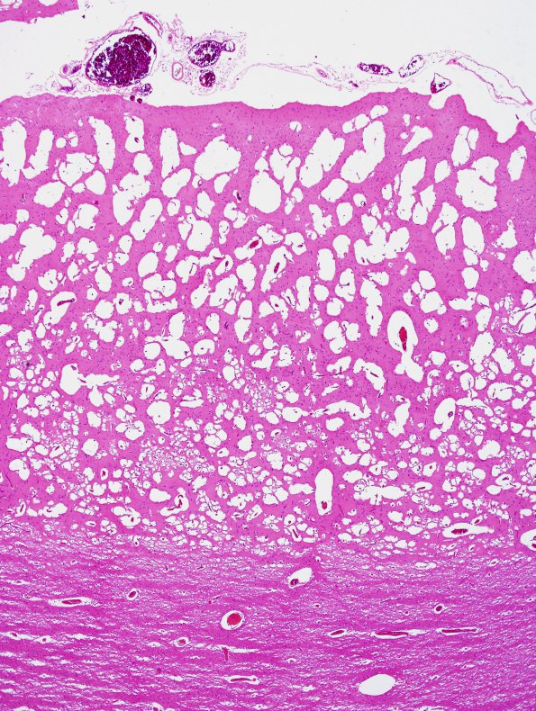 2A2 Artifact, freeze-thaw, FTLD (Case 1) L2 H&E 1