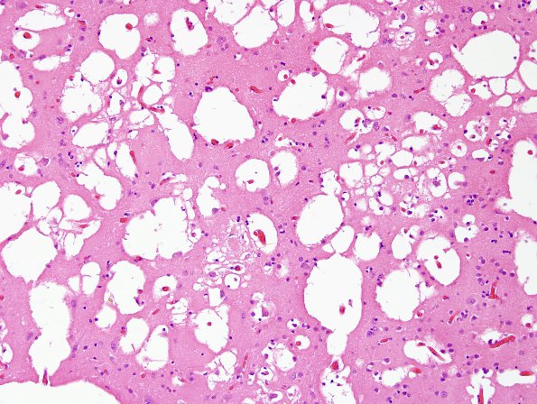 2A3 Artifact, freeze-thaw, FTLD (Case 1) L2 H&E 2