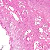 3A2 Artifact, ice crystals (Case 4) L1 H&E 1