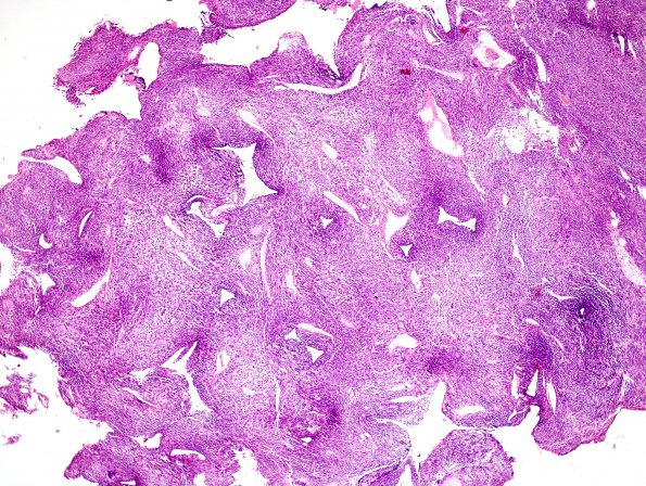 3 Artifact, sponge (Case 2) Meningioma