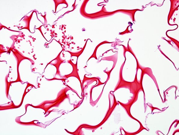 6A3 Artifact, surgical material mimicking vascular malformation (Case 7) H&E 5