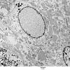 1A1 Artifact, nuclear, mimics viral inclusion (Case 1) EM 048 - Copy