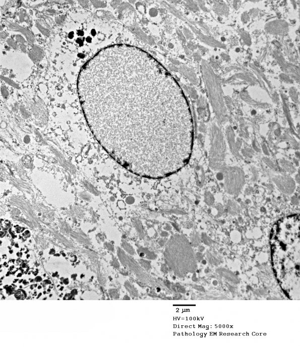 1A1 Artifact, nuclear, mimics viral inclusion (Case 1) EM 048 - Copy