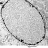 1A2 Artifact, nuclear, mimics viral inclusion (Case 1) EM 050 - Copy