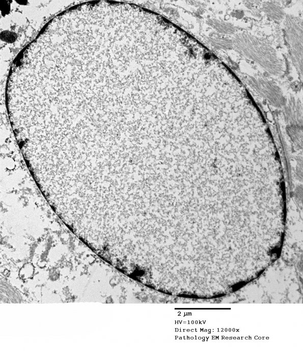 1A2 Artifact, nuclear, mimics viral inclusion (Case 1) EM 050 - Copy