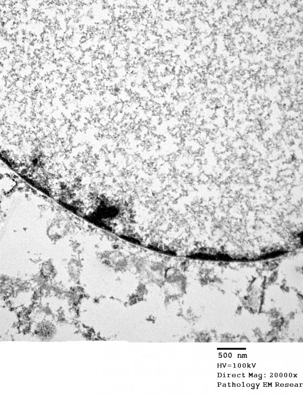 1A3 Artifact, nuclear, mimics viral inclusion (Case 1) EM 051 - Copy