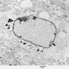 1A4 Artifact, nuclear, mimics viral inclusion (Case 1) EM 064 - Copy